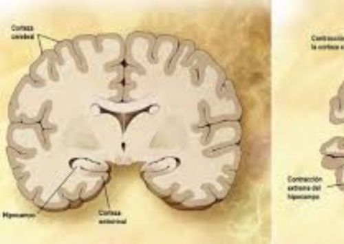 Imagem de Doença de Alzheimer: quando suspeitar?